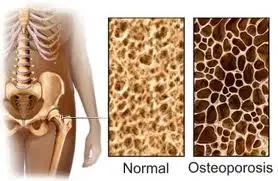 Cómo evitar y tratar la osteoporosis