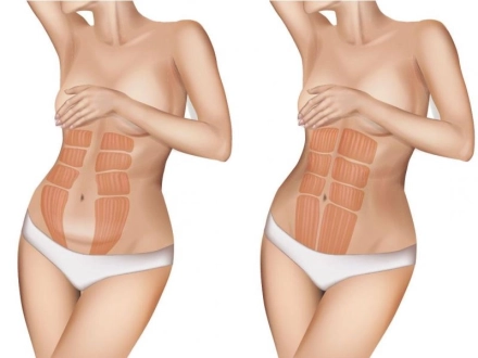 Diástasis abdominal y manipulación visceral 