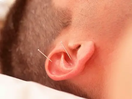 Eficacia de la acupuntura auricular en el tratamiento del dolor oncológico
