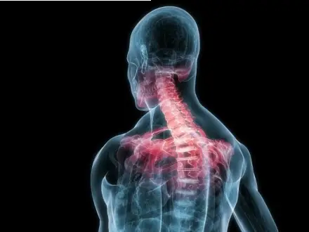 La Osteopatía en dolores agudos de cuello