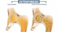 OSTEOPOROSIS, MENOPAUSIA Y MEDICINA NATURAL