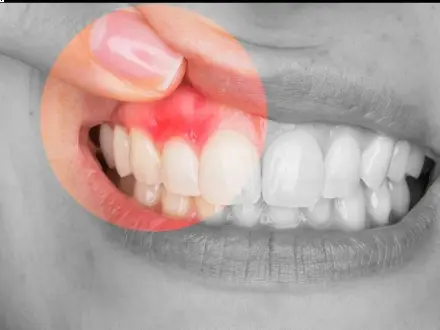 Terapia homeopática en el tratamiento de la periodontitis crónica